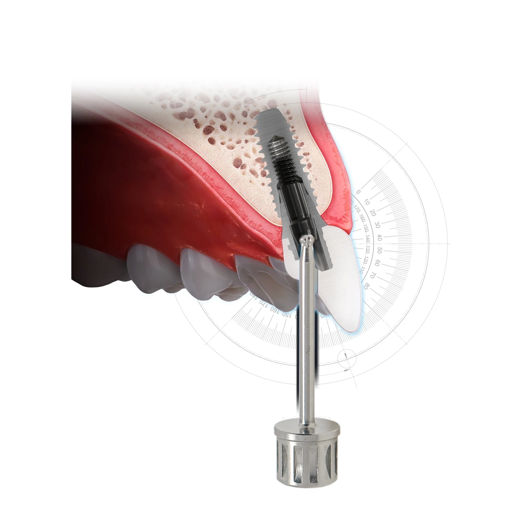 Dental  Implant Abutment Screwdriver Tool 25 Degree Angled For ITI Straumann Implant Tool Restoration
